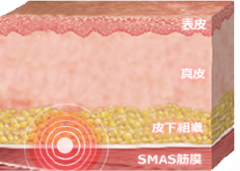 たるみ治療 ウルトラセルQプラス | うさみクリニック(旧 宇佐美